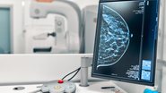 imagem de exame de mamografia - Adobe Stock