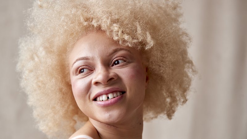 Pessoas com albinismo têm a coloração da pele branca ou em tons um pouco mais amarronzados - Envato
