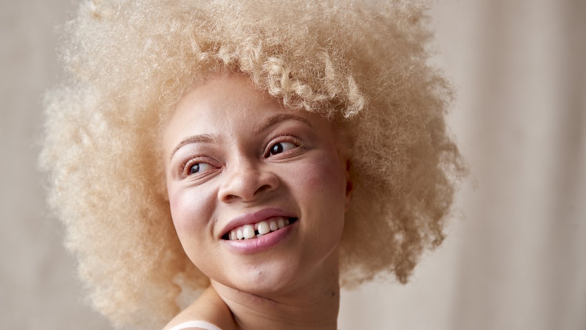 Pessoas com albinismo têm a coloração da pele branca ou em tons um pouco mais amarronzados - Envato