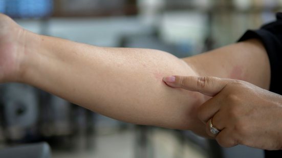 A condição causa inflamação na pele, ocasionando lesões e coceiras intensas - Envato