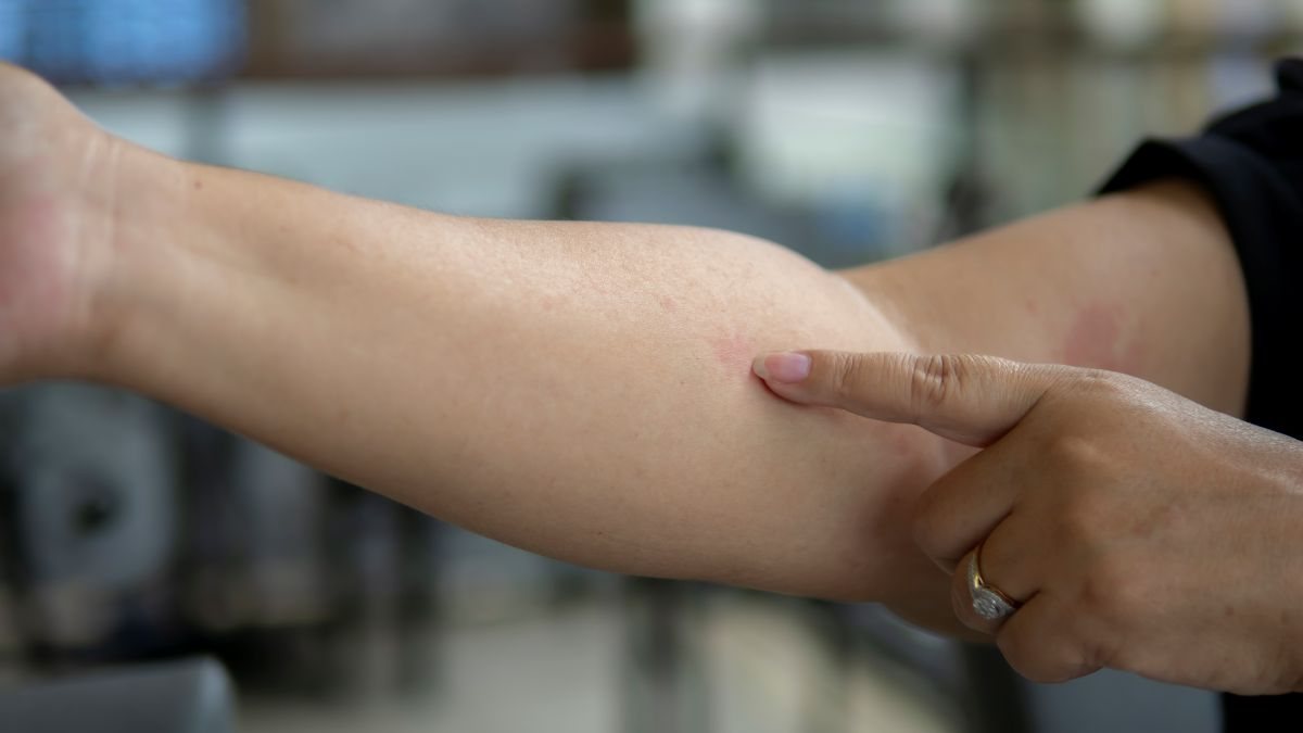 A condição causa inflamação na pele, ocasionando lesões e coceiras intensas - Envato