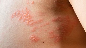 Herpes-zóster, também chamado de cobreiro, é uma condição de saúde causada pelo vírus varicela-zóster, o mesmo que causa a catapora - Envato