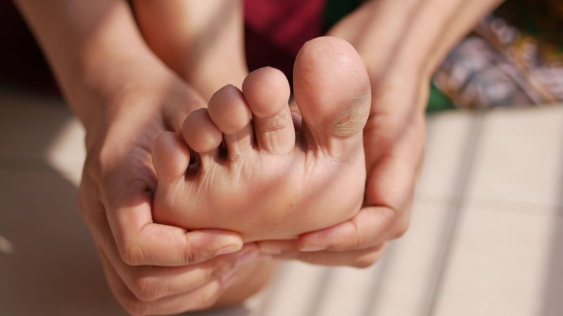 O engrossamento da pele é uma reação natural do corpo para proteger a área - Envato Elements