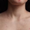 Doença de pele que pode ser confundida com acne pode levar anos para ser diagnosticada - Foto: Envato Elements