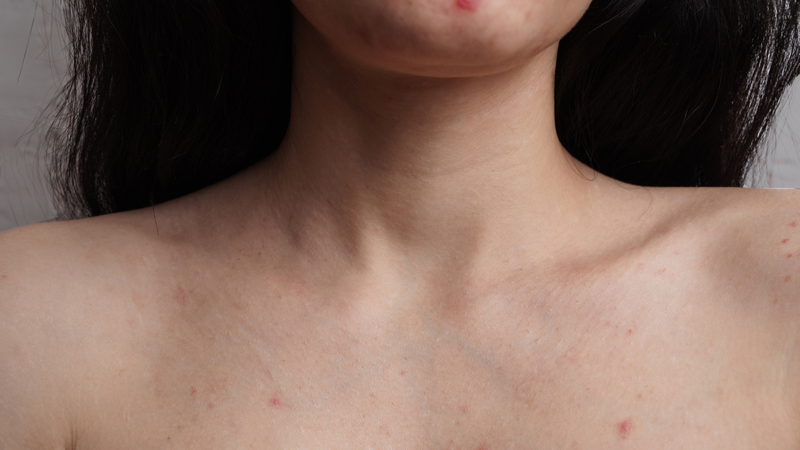 Doença de pele que pode ser confundida com acne pode levar anos para ser diagnosticada - Foto: Envato Elements