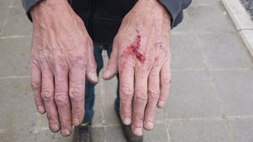 Mais da metade dos casos (50,8%) afetaram indivíduos de 70 a 84 anos, com 87,6 mil denúncias registradas - Envato