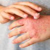 Em quadros mais avançados ou antigos, a pele pode apresentar espessamento ou áreas esbranquiçadas, resultado da inflamação repetitiva - Foto: Envato Elements