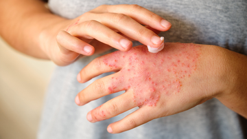 Em quadros mais avançados ou antigos, a pele pode apresentar espessamento ou áreas esbranquiçadas, resultado da inflamação repetitiva - Foto: Envato Elements