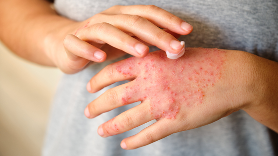 Em quadros mais avançados ou antigos, a pele pode apresentar espessamento ou áreas esbranquiçadas, resultado da inflamação repetitiva - Foto: Envato Elements