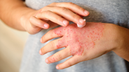 Em quadros mais avançados ou antigos, a pele pode apresentar espessamento ou áreas esbranquiçadas, resultado da inflamação repetitiva - Foto: Envato Elements