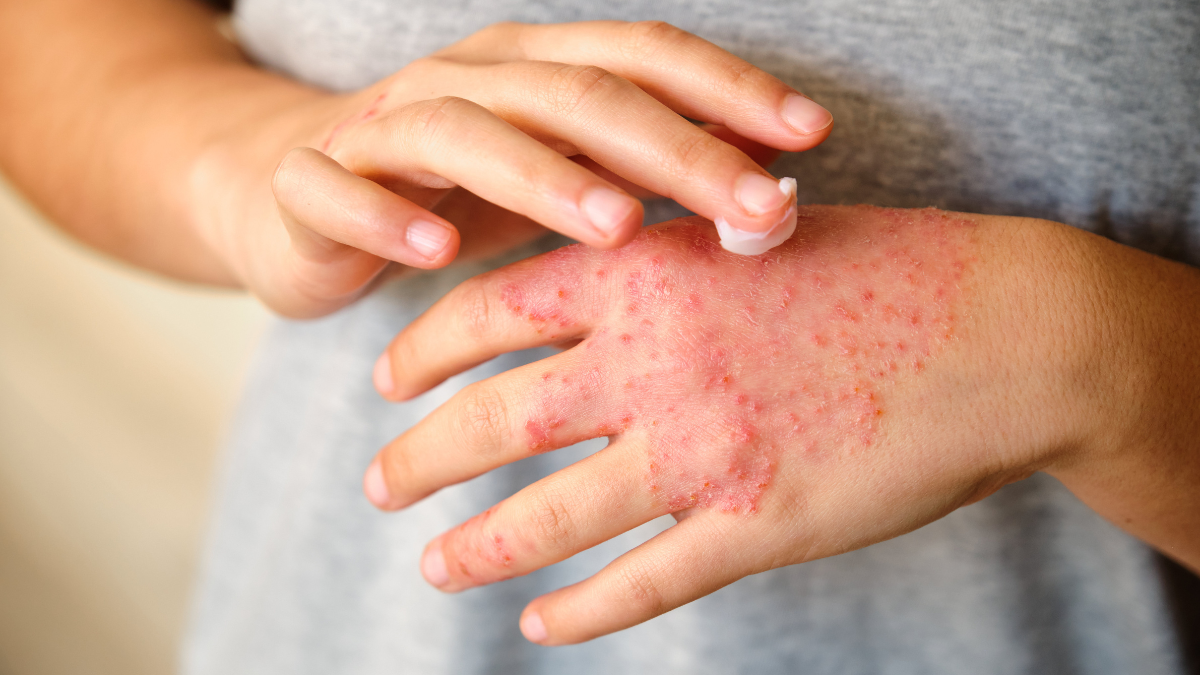 Em quadros mais avançados ou antigos, a pele pode apresentar espessamento ou áreas esbranquiçadas, resultado da inflamação repetitiva - Foto: Envato Elements