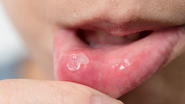 As aftas são pequenas feridas que surgem na língua, lábios ou interior da boca - Envato
