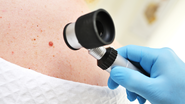 O carcinoma basocelular é o tipo mais frequente de câncer de pele - Foto: Envato Elements