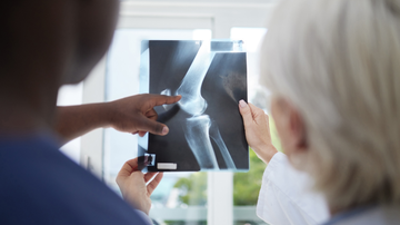 O que é osteoporose? Descubra como prevenir a doença que enfraquece os ossos