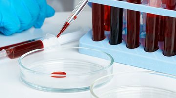 O exame de sangue, chamado de Galleri, teve resultado positivo no rastreamento de múltiplos tipos de câncer, porém, ainda não está disponível no Brasil - Envato