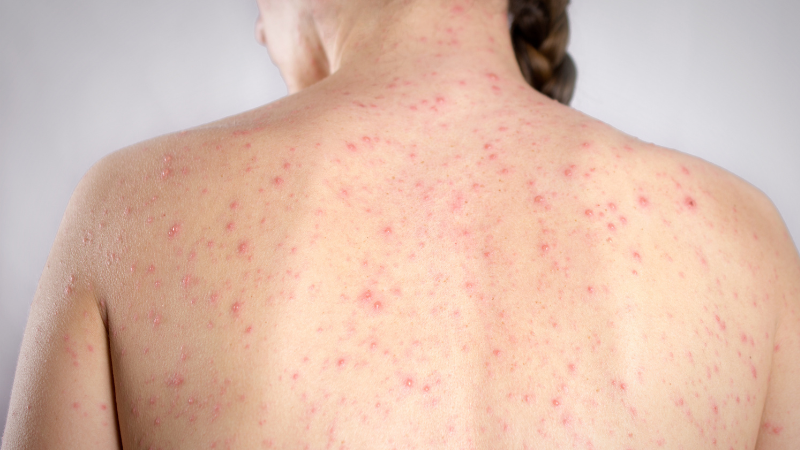 Américas foram a primeira região do mundo a eliminar o sarampo duas vezes e agora perdem o status de área livre da doença - Foto: Adobe Stock