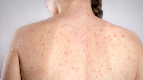 Américas foram a primeira região do mundo a eliminar o sarampo duas vezes e agora perdem o status de área livre da doença - Foto: Adobe Stock