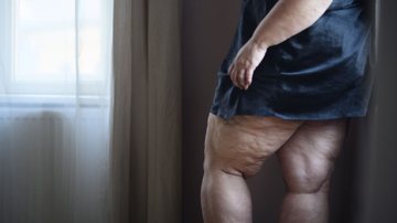 Lipedema compromete a mobilidade, a autoestima e o bem-estar, além de ter agravantes após a menopausa - Envato