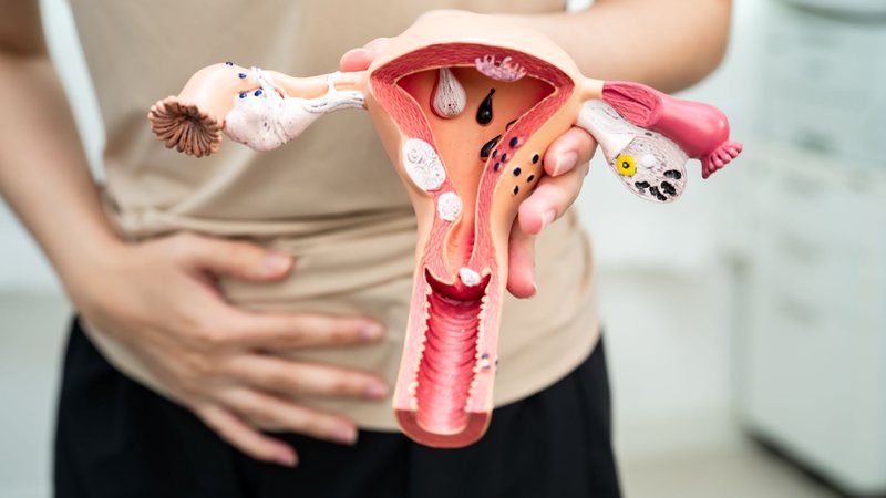 Doença causa cólica intensa, sangramento prolongado e até dificuldade para engravidar, explica especialista - Envato