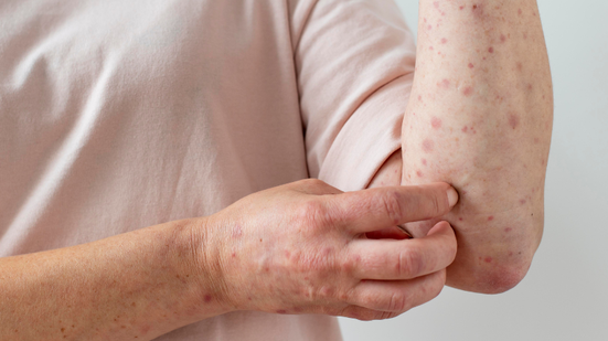 Entre 2014 e 2023, o número de casos de sífilis adquirida por 60+ saltou 408% chegando a 21.613 registros - Adobe Stock