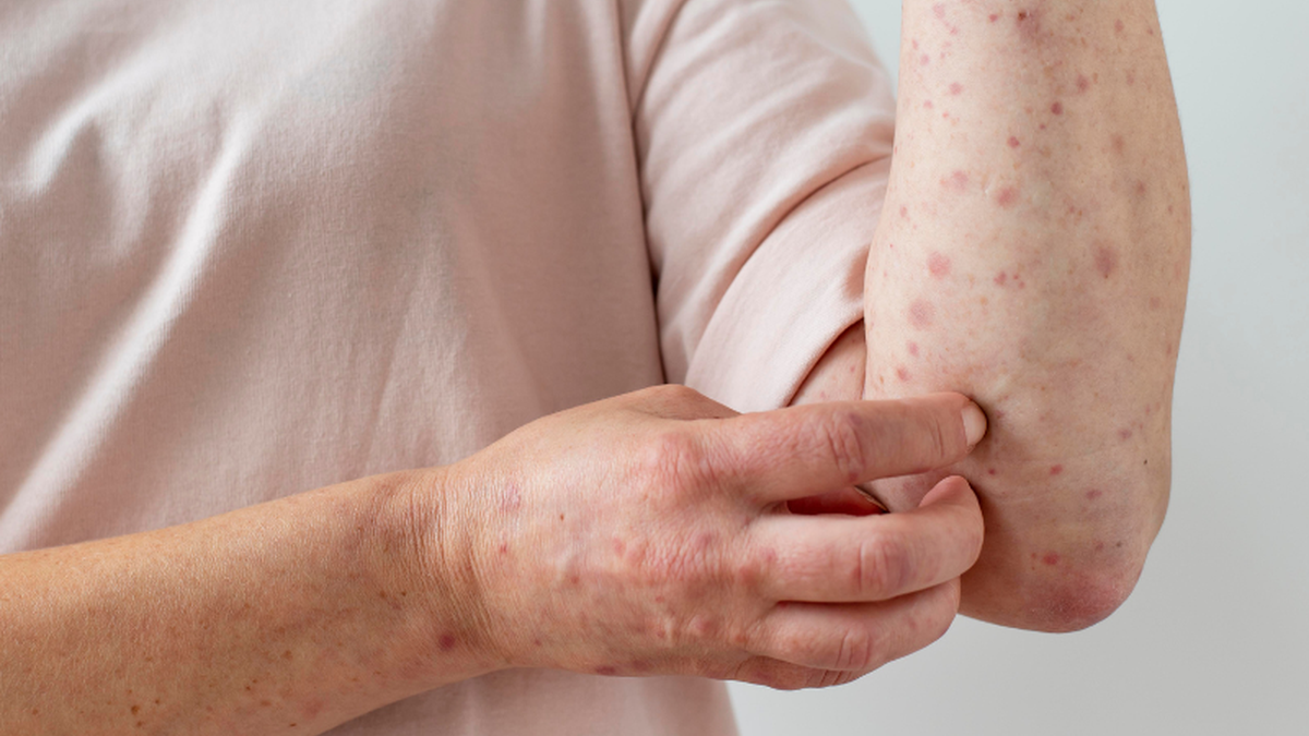 Entre 2014 e 2023, o número de casos de sífilis adquirida por 60+ saltou 408% chegando a 21.613 registros - Adobe Stock