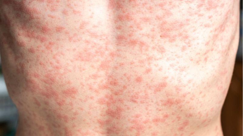 Este é o segundo caso de sarampo registrado no Estado neste ano; o primeiro ocorreu em abril, também na capital - Adobe Stock