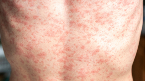 Este é o segundo caso de sarampo registrado no Estado neste ano; o primeiro ocorreu em abril, também na capital - Adobe Stock