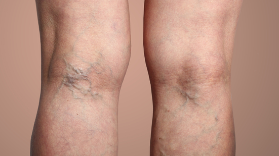 Trombose acontece por conta da formação de um coágulo sanguíneo em uma ou mais veias grandes das pernas e das coxas - Adobe Stock