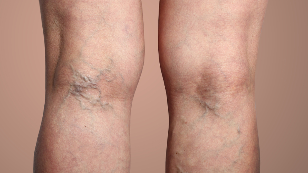 Trombose acontece por conta da formação de um coágulo sanguíneo em uma ou mais veias grandes das pernas e das coxas - Adobe Stock