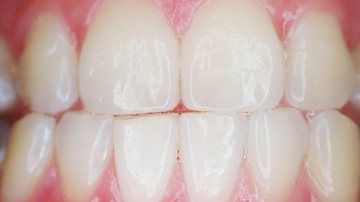 Quebrar um dente pode causar dor, perda dentária e impacto na autoestima - Banco de Imagens / Pixabay