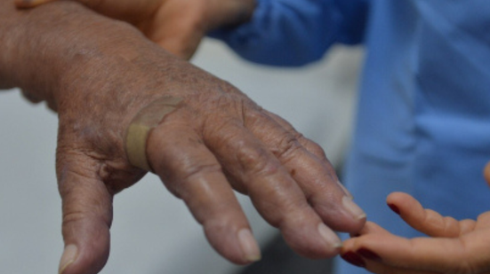 Governo alerta que a hanseníase continua sendo um importante desafio à saúde pública - Gutember Brito/Instituto Oswaldo Cruz