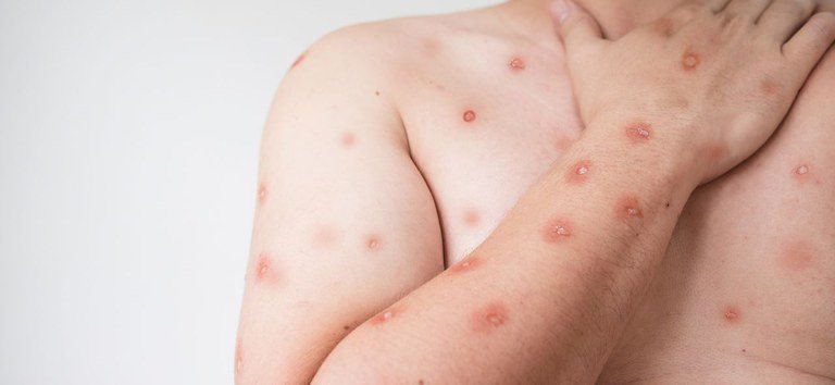 Erupções cutâneas são um dos sintomas da Mpox (anteriormente conhecida como varíola dos macacos), que é uma doença viral zoonótica - Divulgação / Ministério da Saúde