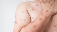 Erupções cutâneas são um dos sintomas da Mpox (anteriormente conhecida como varíola dos macacos), que é uma doença viral zoonótica - Divulgação / Ministério da Saúde
