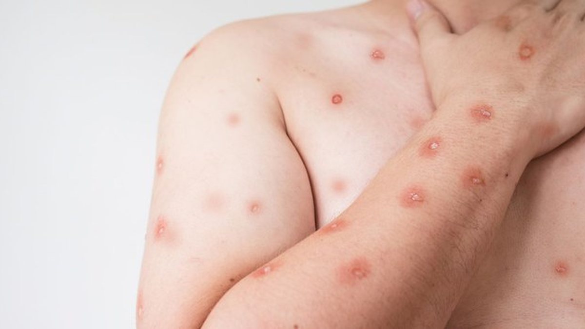 Erupções cutâneas são um dos sintomas da Mpox (anteriormente conhecida como varíola dos macacos), que é uma doença viral zoonótica - Divulgação / Ministério da Saúde