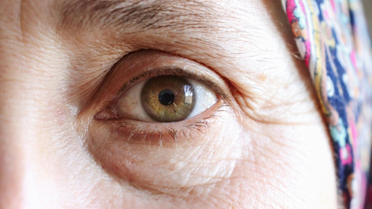 Especialistas explicam os cuidados preventivos e os tratamentos disponíveis para evitar o agravamento da síndrome do olho seco; saiba mais - Pexels