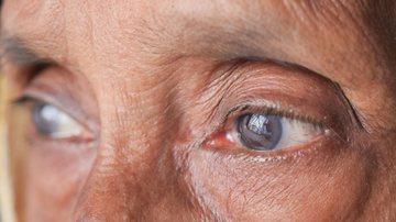 Cirurgia de catarata: como escolher a lente intraocular mais adequada