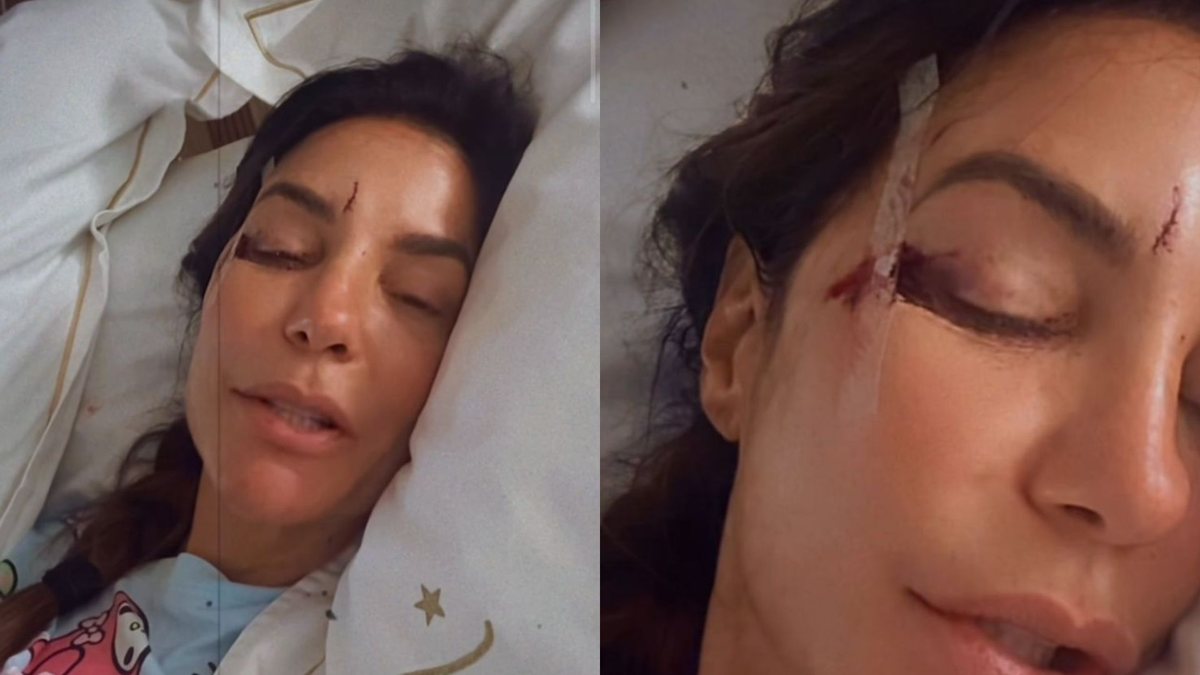 Ivete Sangalo teve dois cortes no rosto após cair por desmaio - Reprodução / Instagram @ivetesangalo