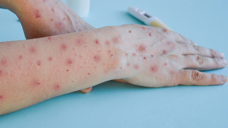 Vacinação contra a mpox visa grupos com maior risco de evoluir para formas graves da doença - Adobe Stock