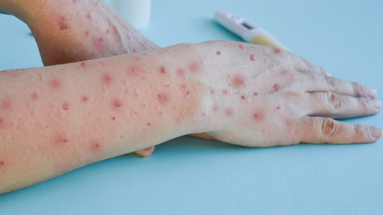 Vacinação contra a mpox visa grupos com maior risco de evoluir para formas graves da doença - Adobe Stock