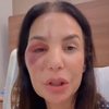 Ivete Sangalo detalhou o diagnóstico que recebeu de síndrome vasovagal - Reprodução/Instagram via @ivetesangalo