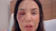 Ivete Sangalo detalhou o diagnóstico que recebeu de síndrome vasovagal - Reprodução/Instagram via @ivetesangalo