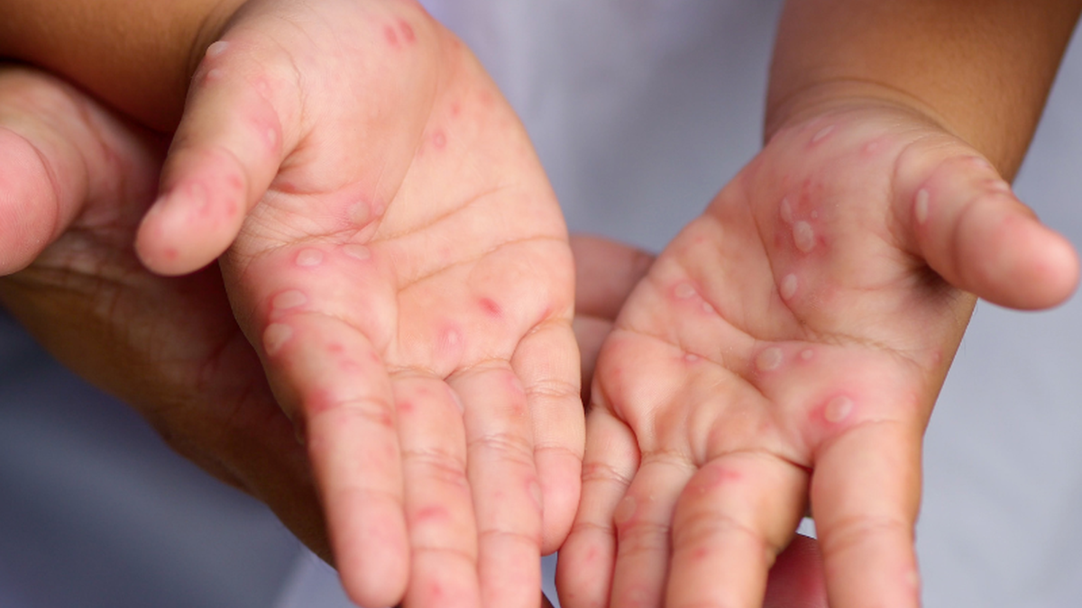 Monitoramento aponta 9 casos prováveis e 539 sob investigação - Adobe Stock