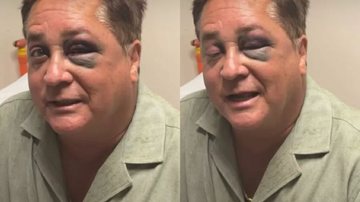 Leonardo com olho roxo após queda em Pescaria - Reprodução / Instagram Poliana Rocha