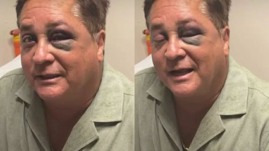 Leonardo com olho roxo após queda em Pescaria - Reprodução / Instagram Poliana Rocha