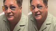Leonardo com olho roxo após queda em Pescaria - Reprodução / Instagram Poliana Rocha