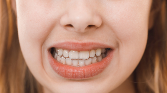 Alterações diretas na mordida, causa desalinhamento dos dentes e força o paciente a projetar a cabeça para a frente - Freepik