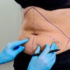 Pele nem sempre consegue se retrair no emagrecimento, levando à necessidade de cirurgia - AdobeStock