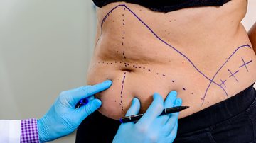 Pele nem sempre consegue se retrair no emagrecimento, levando à necessidade de cirurgia - AdobeStock
