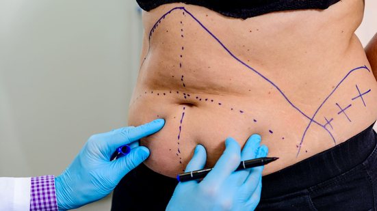 Pele nem sempre consegue se retrair no emagrecimento, levando à necessidade de cirurgia - AdobeStock