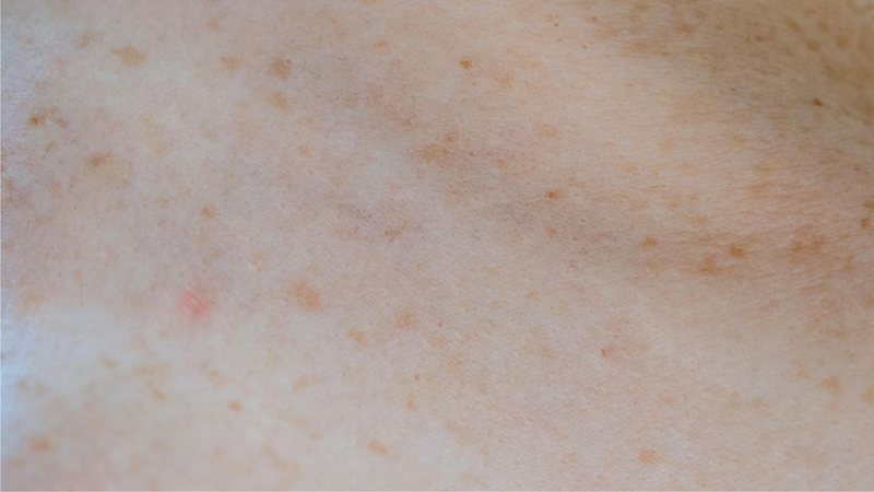 Exposição solar ao longo dos anos causa manchas brancas na pele dos idosos - Pexels